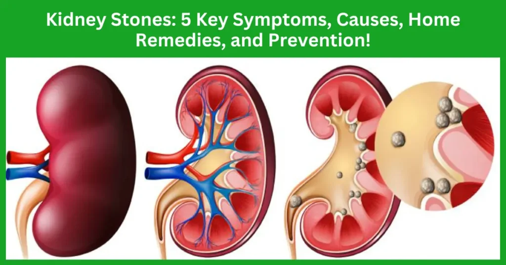 Deciphering Kidney Stones: 5 Key Symptoms, Causes, Home Remedies, and Prevention!