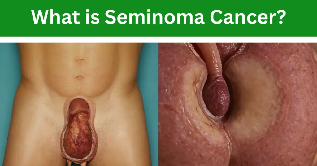 What is Seminoma Cancer? 7 Key Facts You Need to Know!