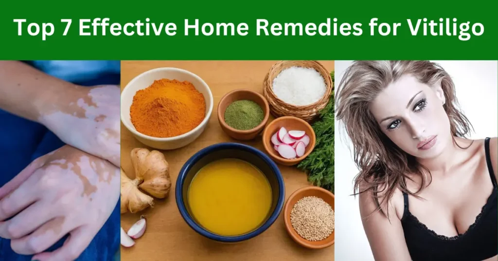 Vitiligo Best Treatment: Top 7 Effective Home Remedies and Tips!